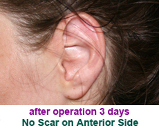 plastic-surgery-prominent-ear 